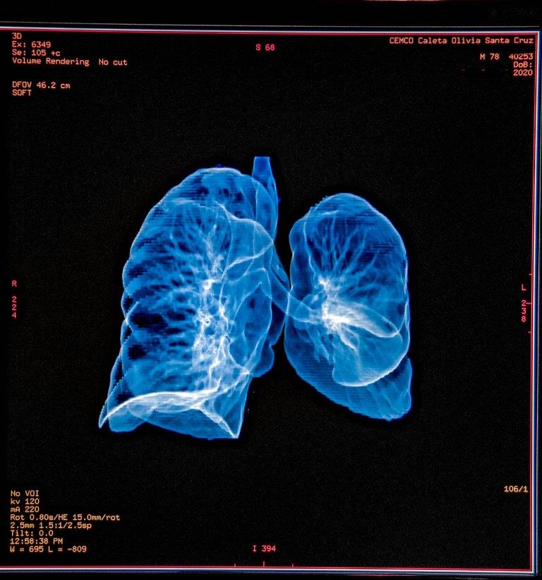 Tomografía de pulmón