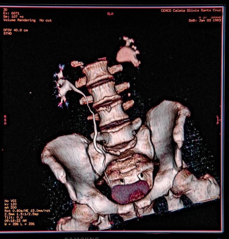 Tomografía de reconstrucción 3D de cadera